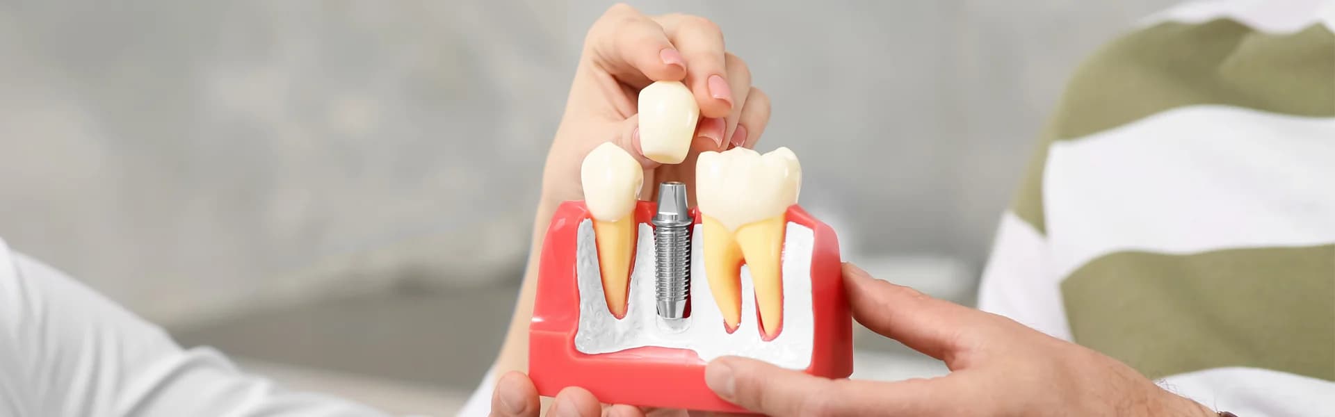 Titanium dental implant post and custom crown illustration at Dr. Patel Dentistry Ajax