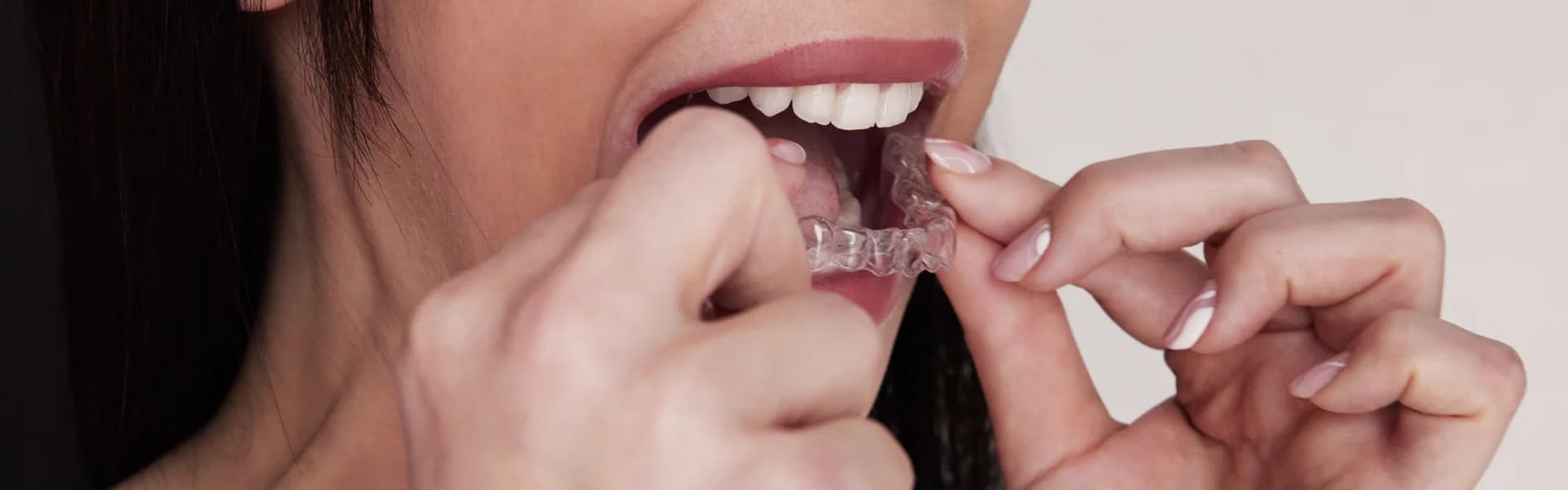 Custom fitted SureSmile aligner tray from Dr. Patel Dentistry