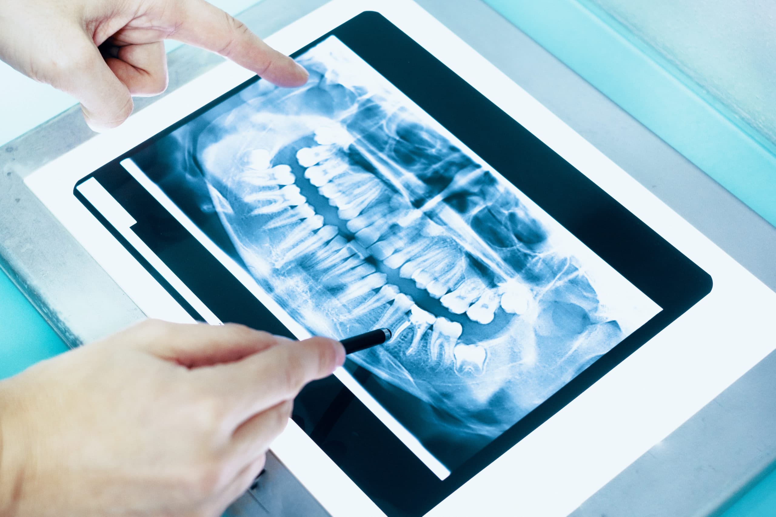 Digital imaging used to plan wisdom teeth removal at Dr. Patel Dentistry