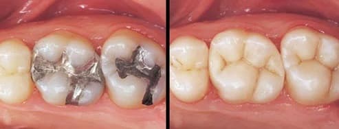 Tooth coloured white filling at Dr. Patel Dentistry in Ajax, ON
