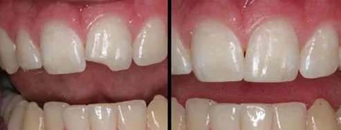 Dental Bonding before and after — Dr. Patel Dentistry Ajax