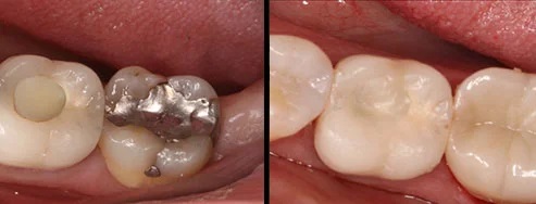 Crowns before and after — Dr. Patel Dentistry Ajax